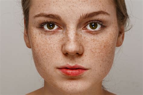 are freckles generic
